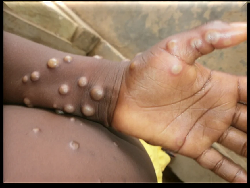 Western Region Records 71% of Ghana’s Mpox Cases, Health Alert Issued