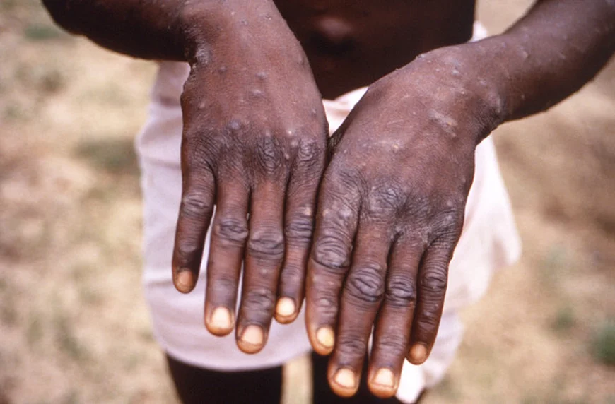 Mpox Outbreak: Ghana Records First Death, Total Cases Rise to 257