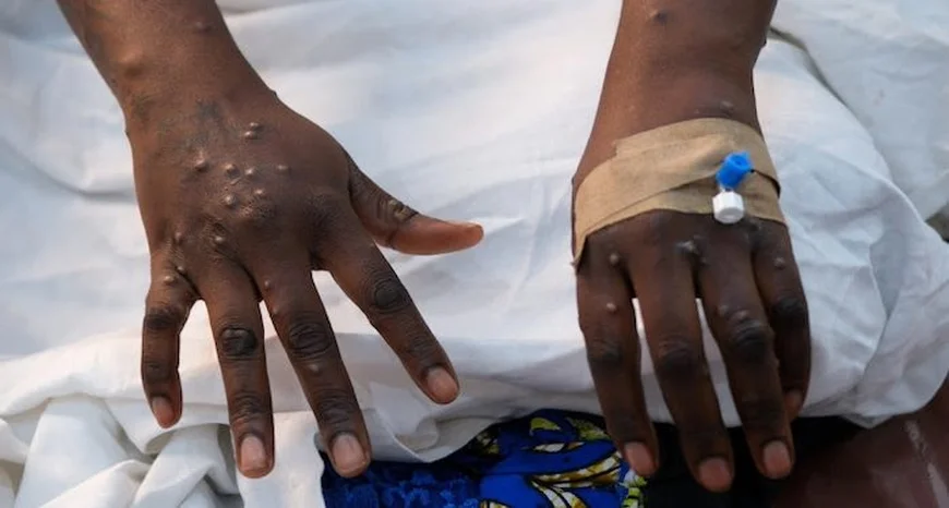GHS to Intensify Mpox Sensitisation Campaigns as Cases Hit 302