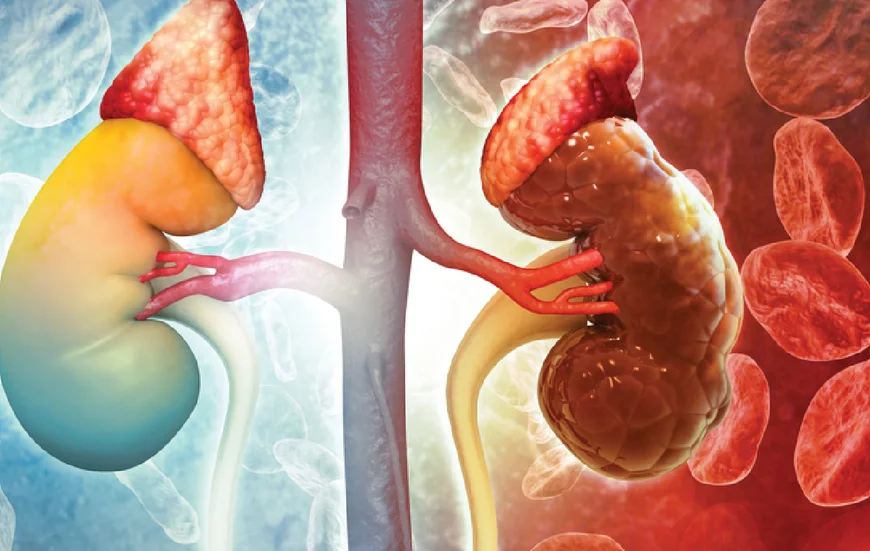 About 4 Million Ghanaians Living With Kidney Disease – Specialist Reveals